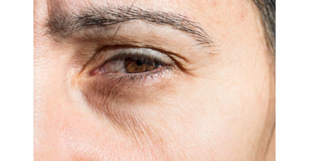 How To Get Rid of Under-Eye Wrinkles