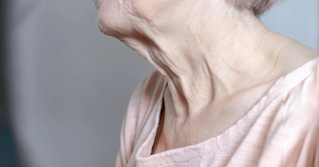 How To Reduce Neck Wrinkles